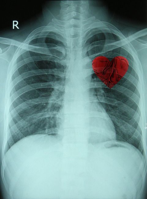 pulmonary tuberculosis thesis pulmonary tuberculosis thesis